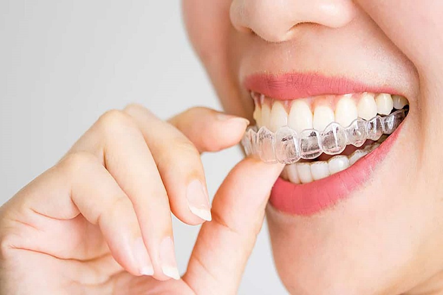 Invisalign Tedavisi